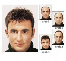 niechirurgiczne uzupełnianie włosów dla mężczyzn , Dorota Olejniczak