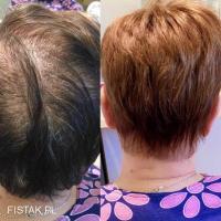 niechirurgiczne uzupełnianie włosów dla mężczyzn , Dorota Olejniczak